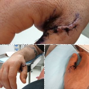 After hand surgery - ouch!