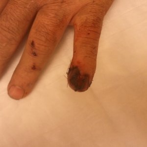 finger carnage - after 1