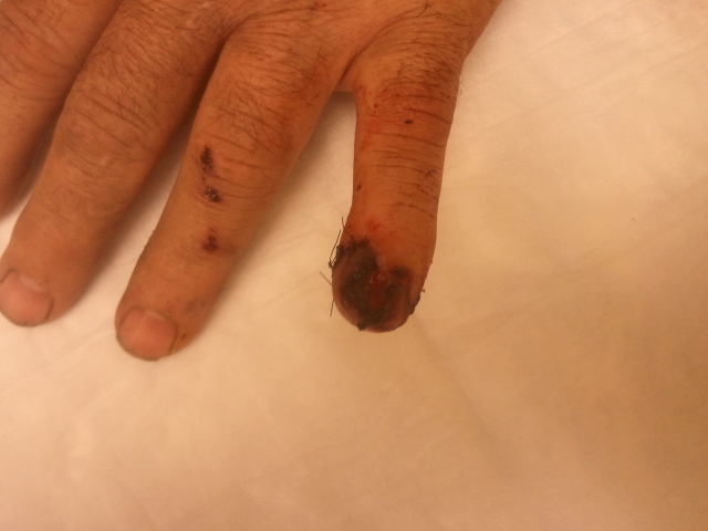 finger carnage - after 1