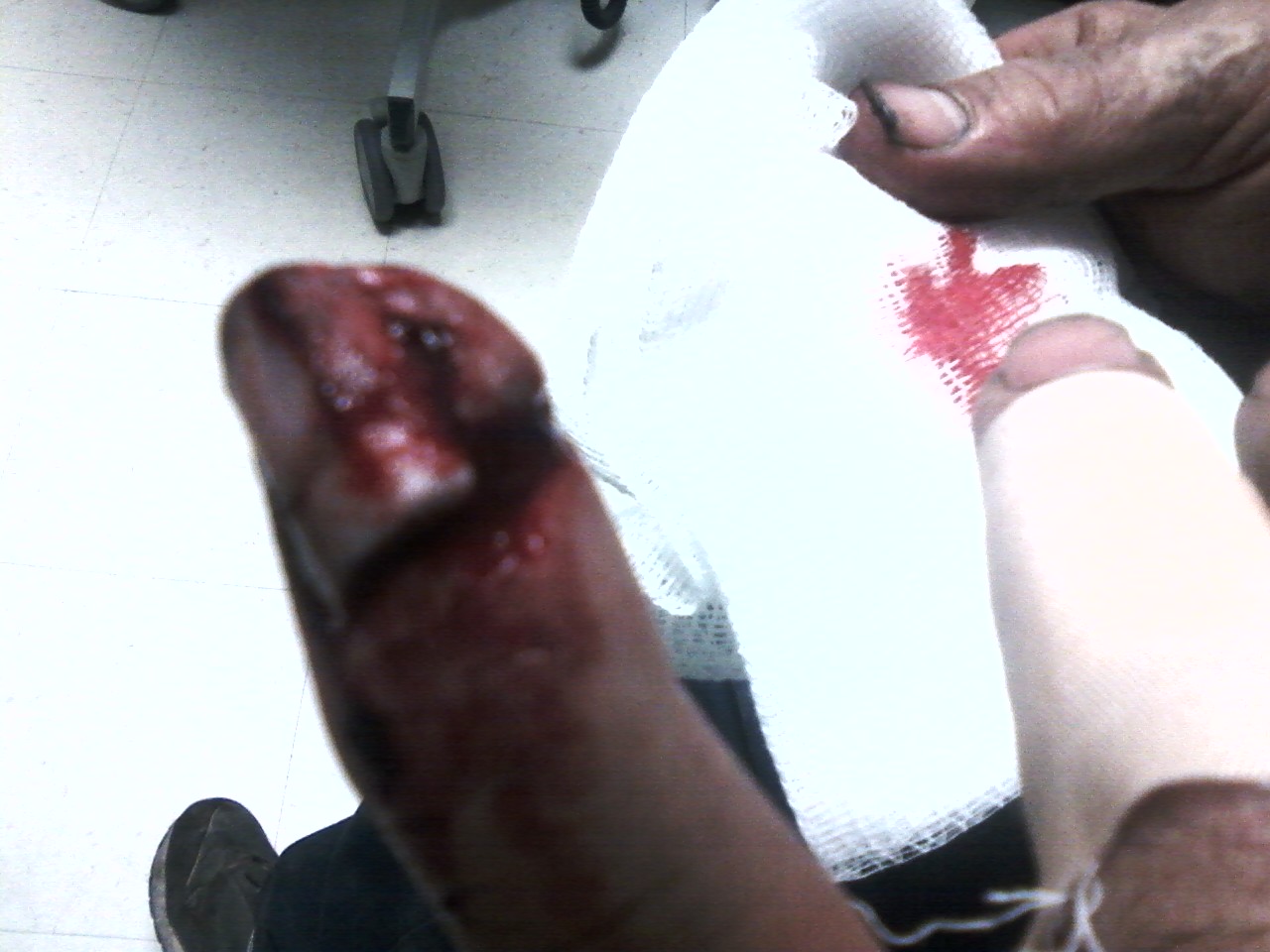 finger carnage - before 1
