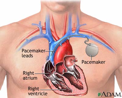 pacemaker